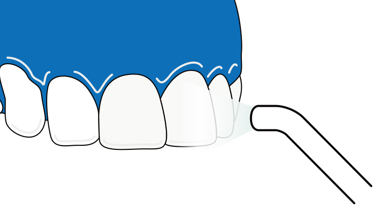 薬剤の浸透と硬化イメージイラスト