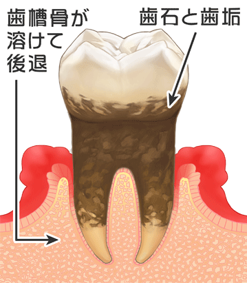 歯周炎(中等度)
